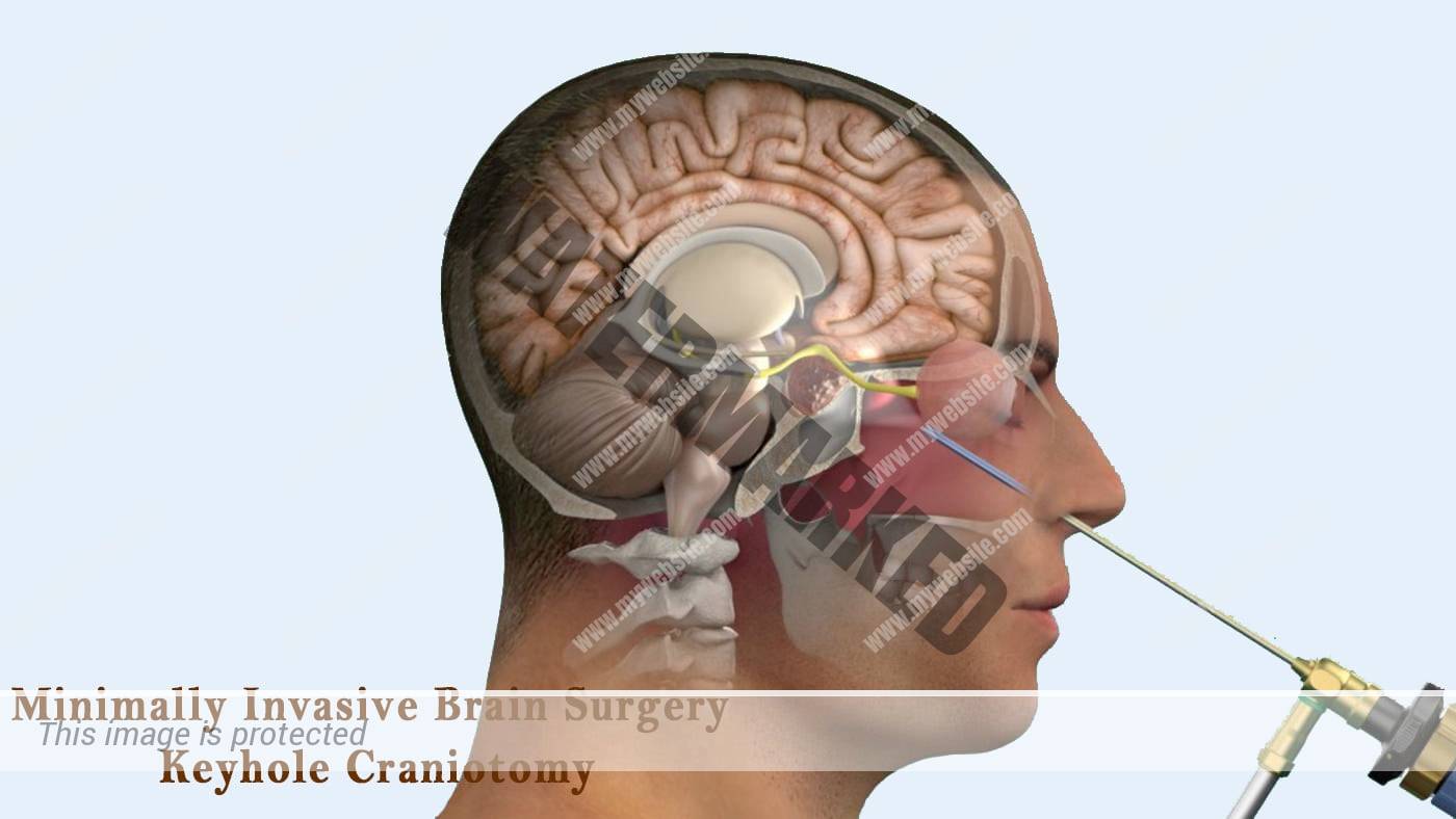 Minimally Invasive Brain Surgery Keyhole Craniotomy